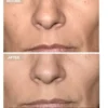 Anti-Aging LED Face Mask The Professional - Anti-aging LED-ansiktsmask